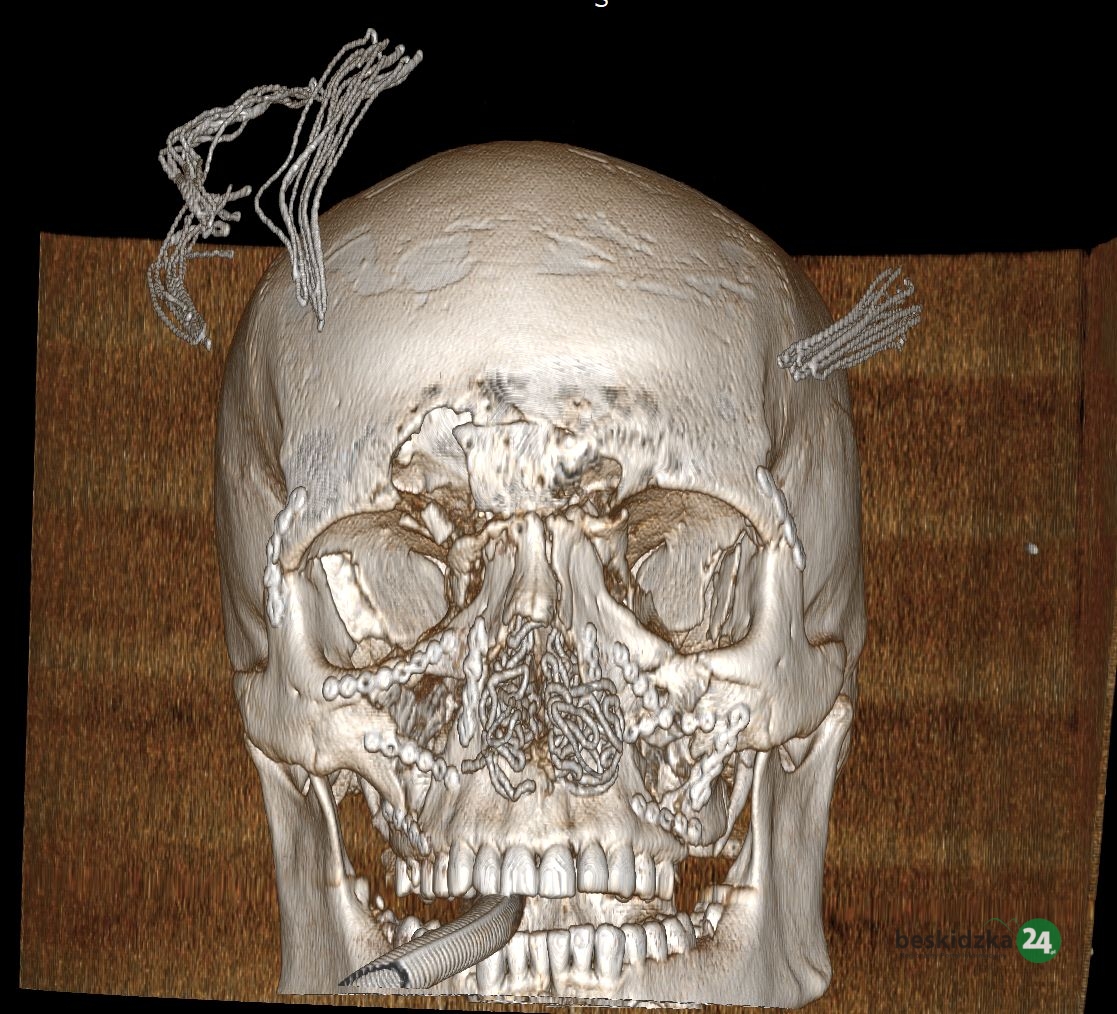 Niezwykły zabieg po wypadku w Mazańcowicach. “Twarz jak rozsypane puzzle”