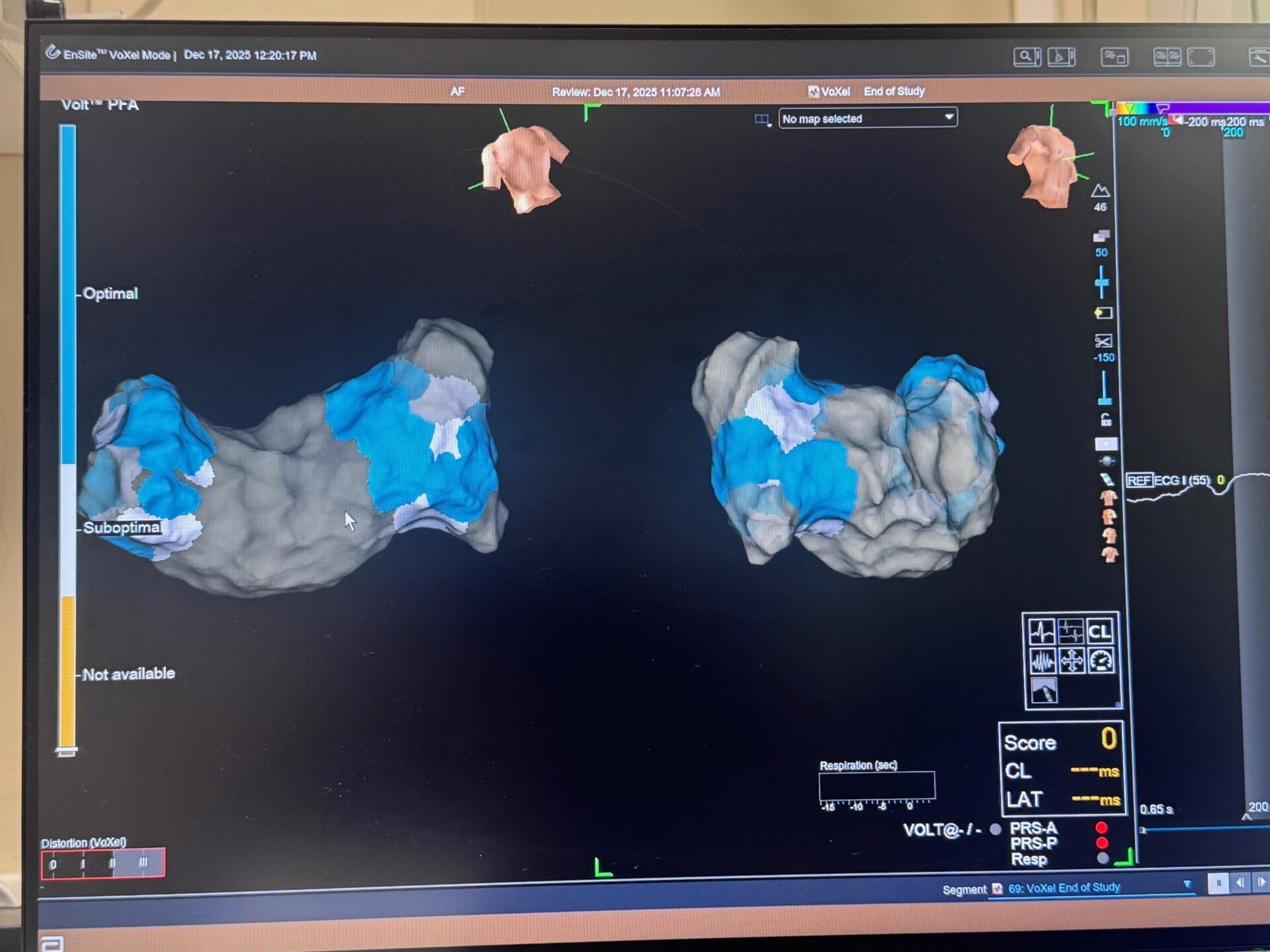 Innowacyjny system Volt już w Bielsku-Białej. Przełom w terapii arytmii